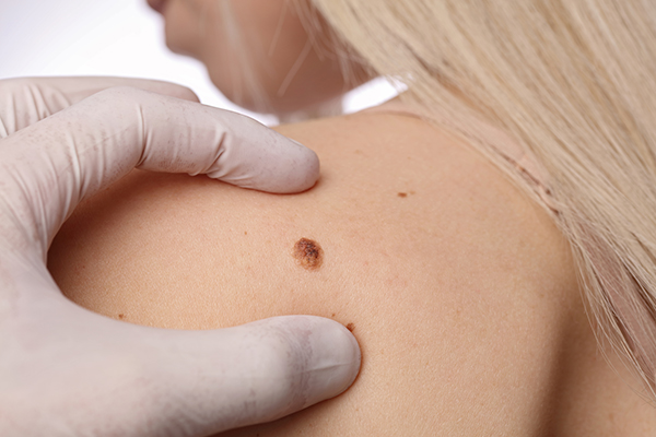 Mole Removal: Mole on woman's shoulder examined by doctor