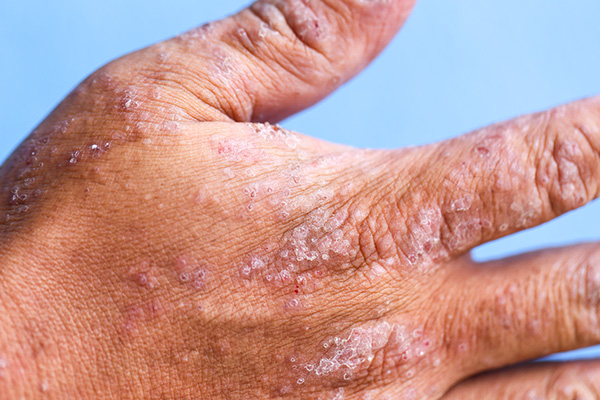 Psoriasis on hand