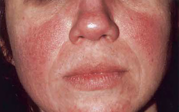 Woman with Rosacea