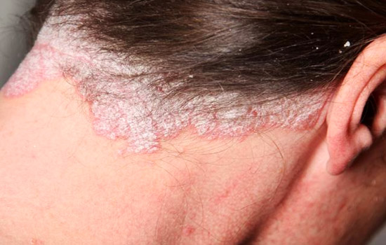 Psoriasis behind woman's neck